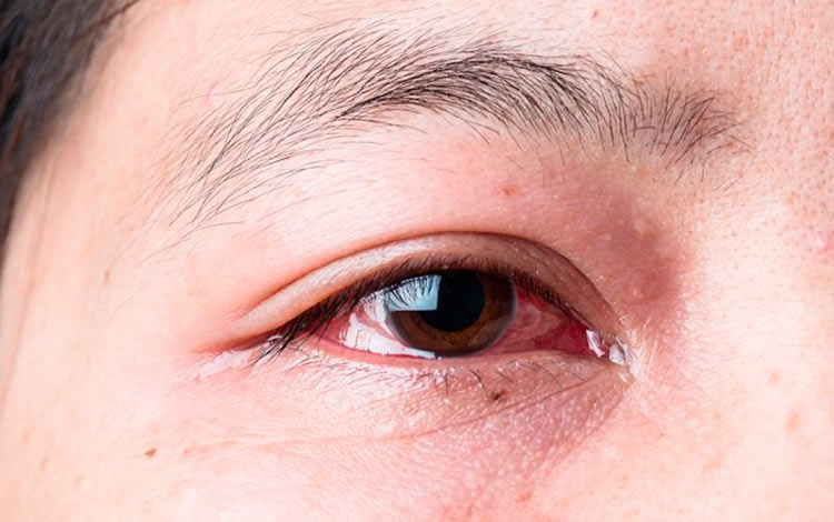 Conjuntivitis hemorrágica.