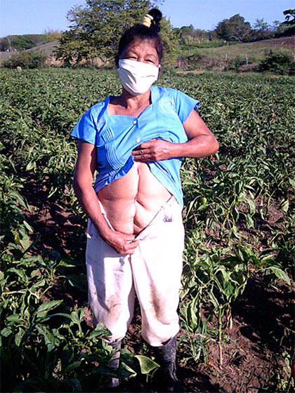 Campesina Marta Arboláez López, de Manicaragua. Campesina Marta Arboláez López, de Manicaragua, muestra cicatriz en su abdomen.