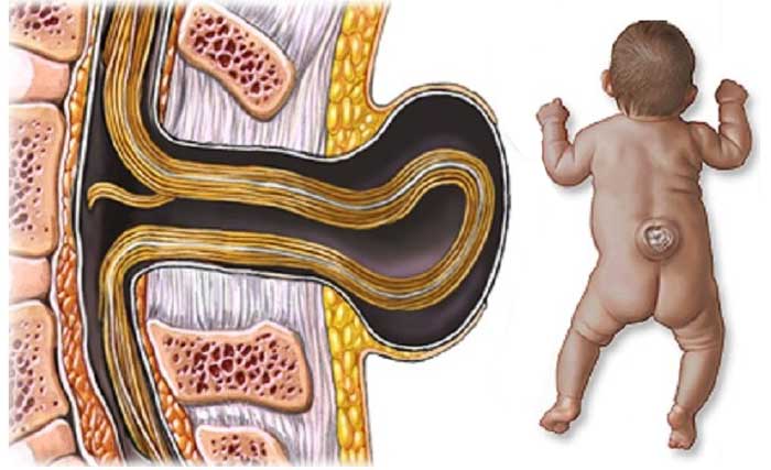 Malformación congénita producida por problemas en el cierre de la columna vertebral.