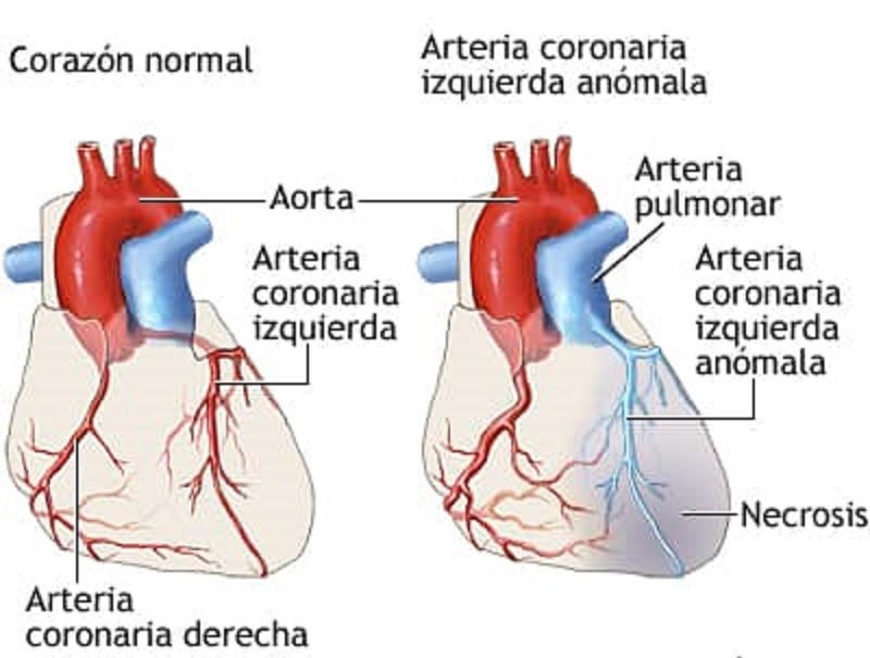 Diagrama comparativo entre un corazón normal y un ALCAPA