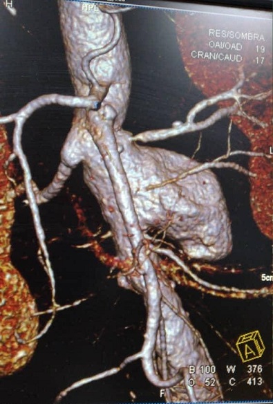 Aneurisma aórtico abdominal del paciente Carlos de León Bení­tez.