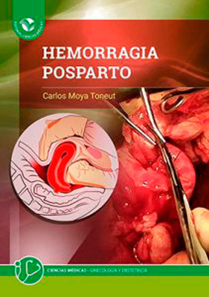 Libro Hermorragia postparto, del Dr. Carlos Moya Toneut.