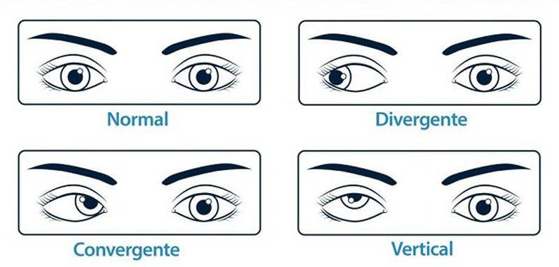 Tipos de estrabismo.