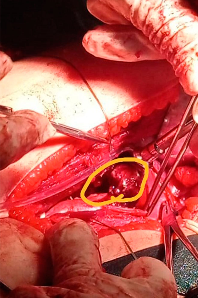 Tumor en el riñón y la vena cava de la niña Karol Águila.