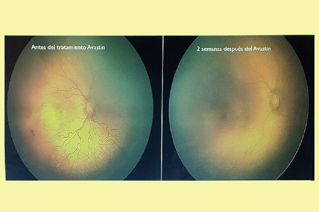 Retinopatía de la prematuridad antes y después del tratamiento.