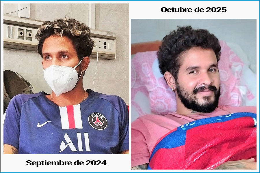 Jadier Juvier pocos días después del trasplante renal y en octubre de 2025.